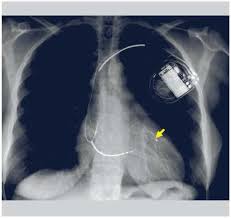 Resynchronisation cardiaque dans le traitement de l’insuffisance cardiaque